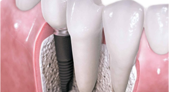 What causes jawbone loss?
