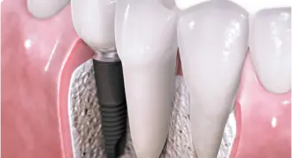 What causes jawbone loss?
